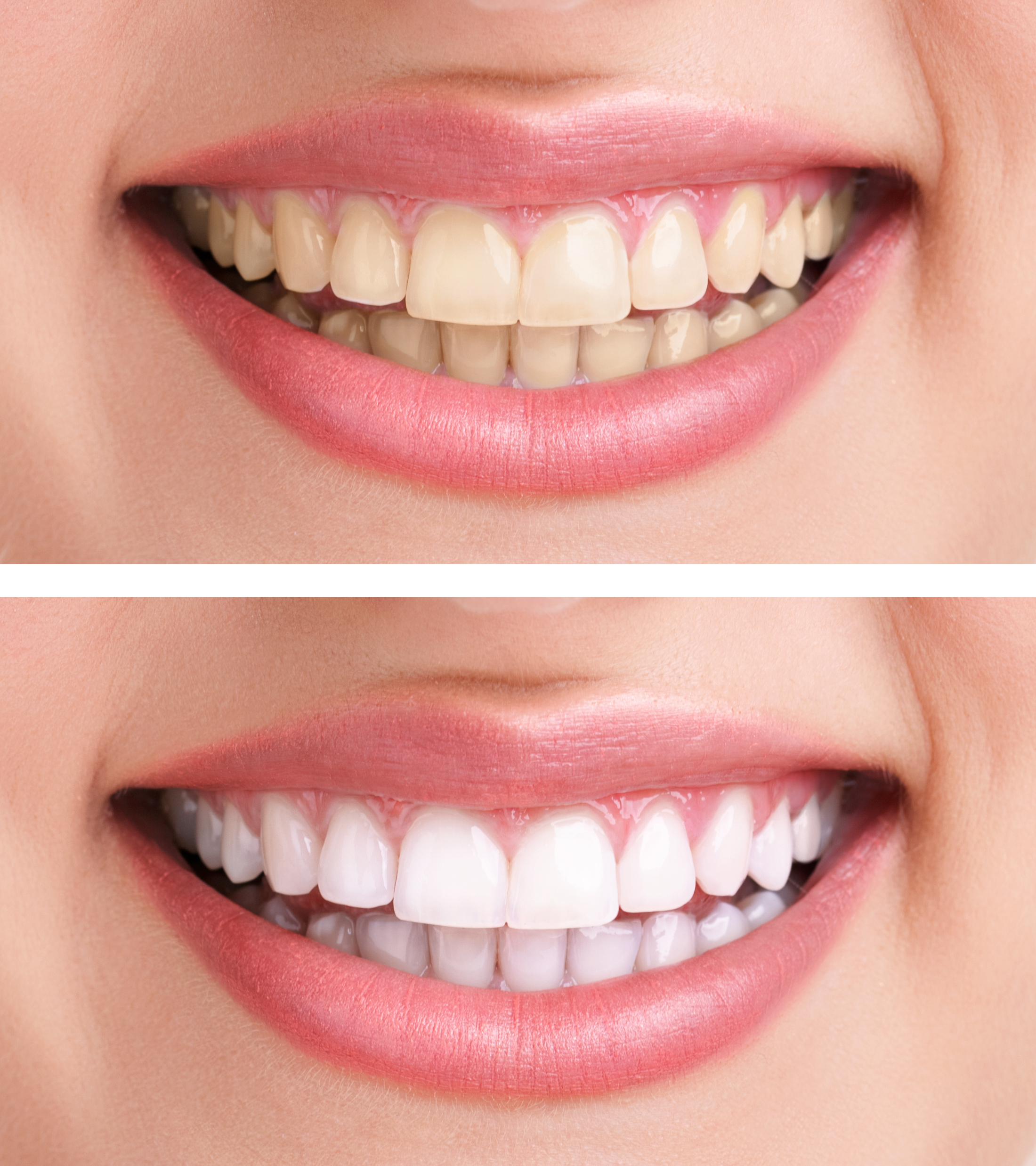 teeth whitening aspendale