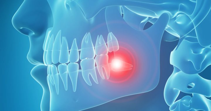 Dentists Wetherill Park - Wisdom Teeth