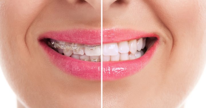 Braces Elizabeth Hills Dental Implant Surgery Abbotsbury Braces Miller