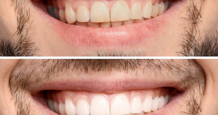 Grace Dental. Teeth Whitening Busby