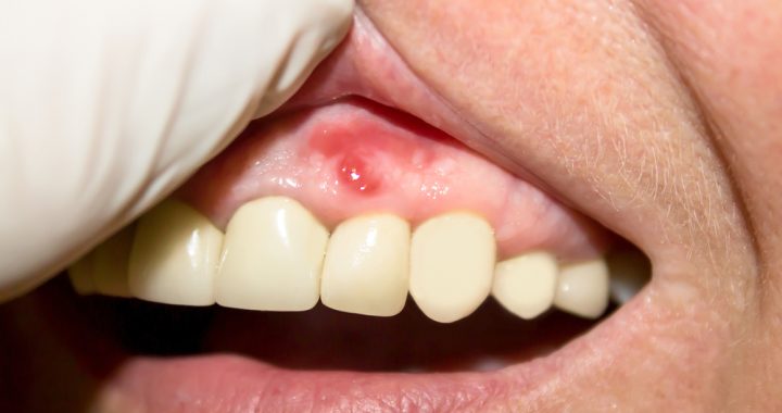 Gum Disease -Dental Clinic Busby